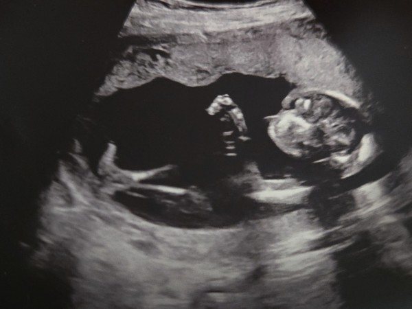 Ultrasound of the baby